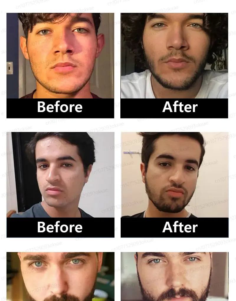 The most effective beard growth essence in 2025, grow a thick beard in 7 days. Chest hair, leg hair, beard and hair growth